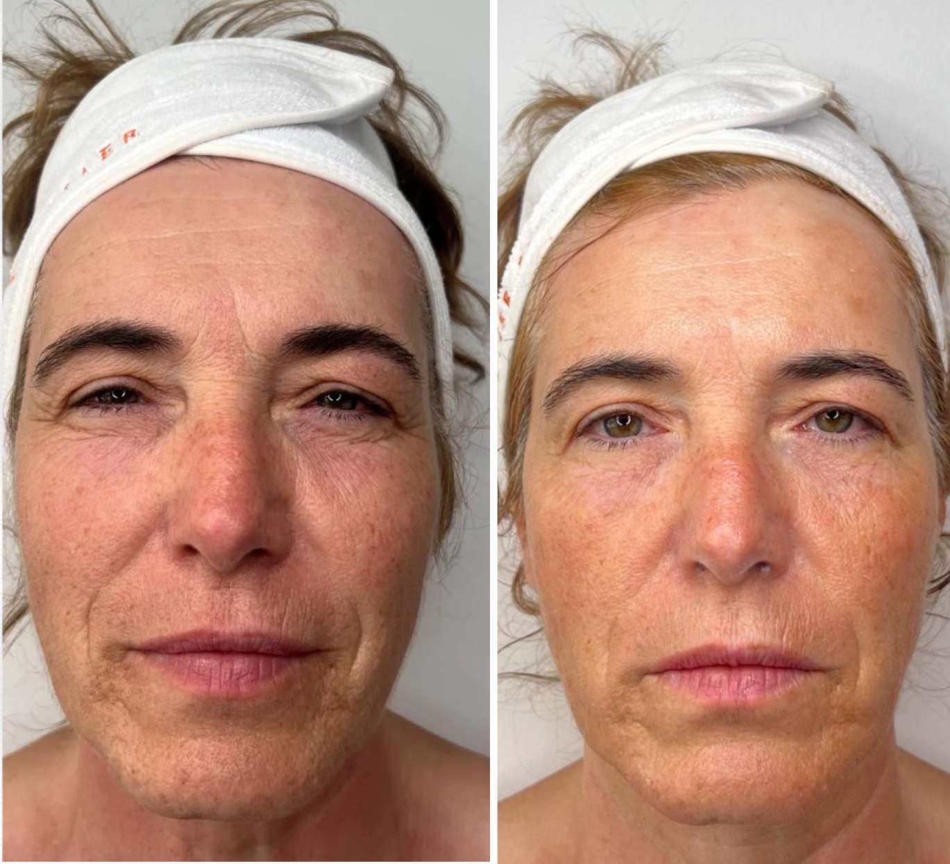 Masque en Poudre Effet Botox – Lifting Immédiat & Anti-Rides Intensif – Promesse Filler - Best seller