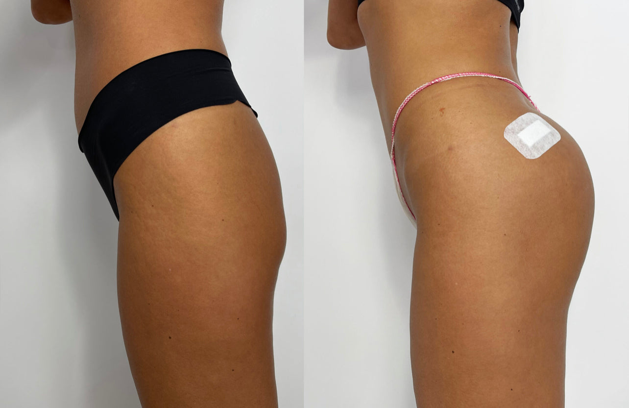 INFINI FILLER B BODY (Volume Fessier et corps)