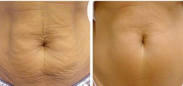 N-ZYMES 1 ENZYMES (Collagenase+Lipase+Hyaluronidase)