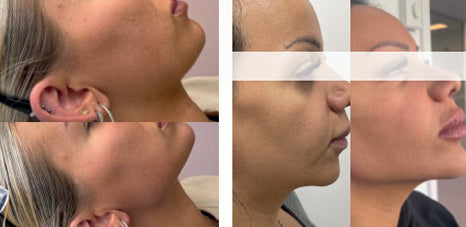 INFINI FILLER XL+ LIDOCAINE