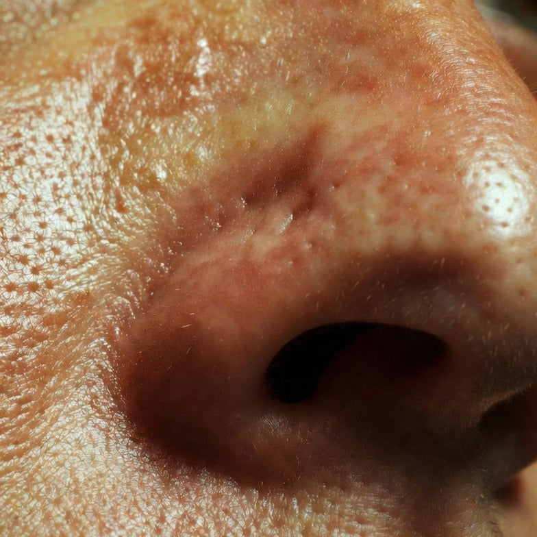 Pores dilatés : comment les resserrer durablement en 2026 ? Le guide complet de la médecine esthétique Image
