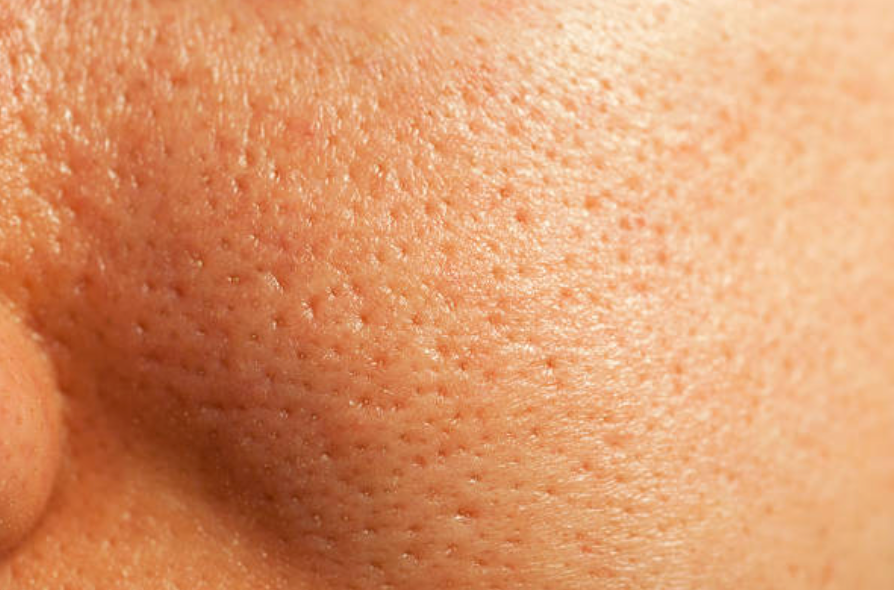 PORES DILATES : LES SOLUTIONS POUR LES RESSERER