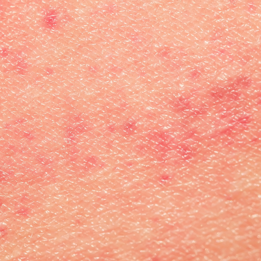 INFLAMMAGING : QUAND L'INFLAMMATION CHRONIQUE FAIT VIEILLIR NOTRE PEAU !