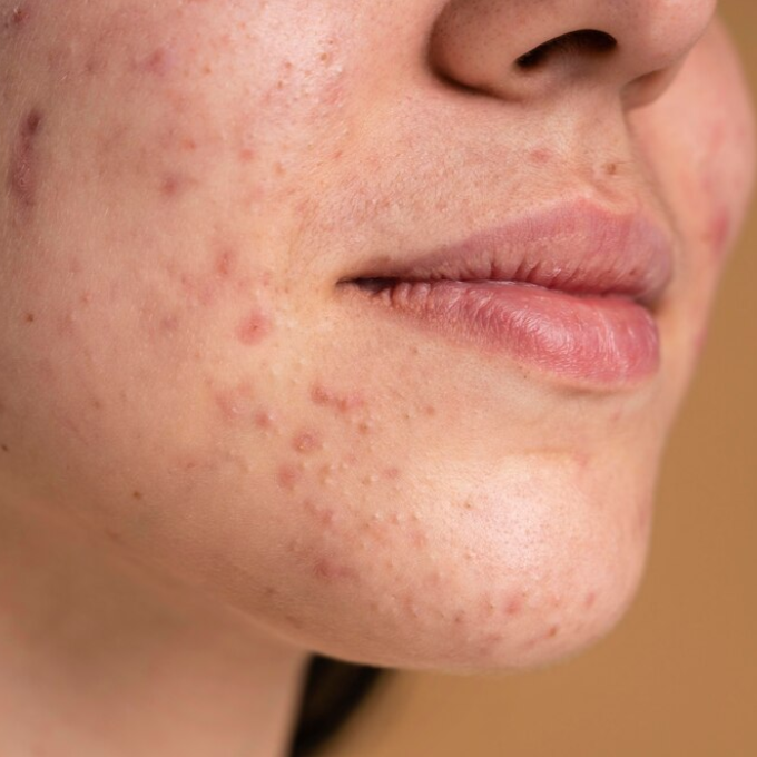 Traitement de l’acné en 2026 : les solutions esthétiques les plus efficaces (microneedling, mésothérapie, peeling + cosmétiques quotidiens) Image