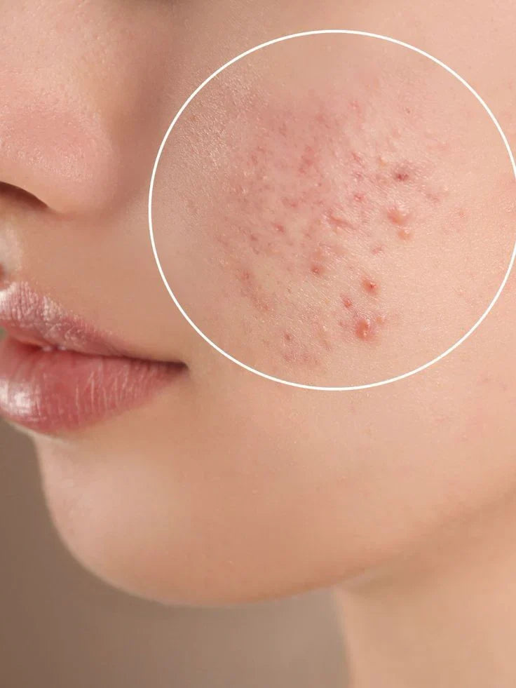 Peeling Acné /Vergetures/ Cicatrices Image