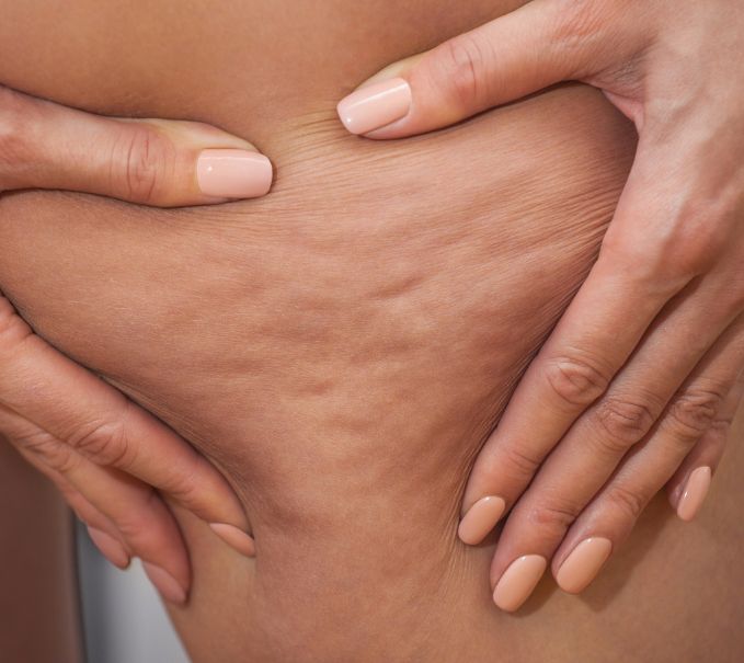 Anti-graisse/cellulite/vergeture Imagen