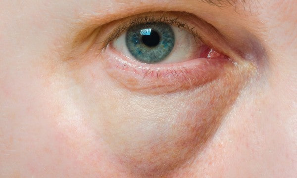Actifs Cernes & Poches : Soins Décongestionnants Contour des Yeux, Sérum cernes bleues et brunes, réduction poches sous les yeux, cocktail microneedling yeux, décongestionner le regard, acide hyaluronique contour des yeux, peptides drainants. Bild