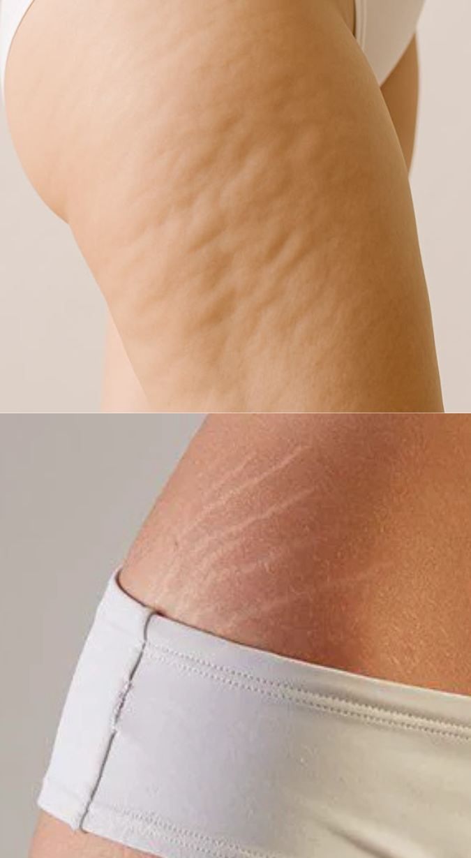 Anti cellulite / vergetures Bild