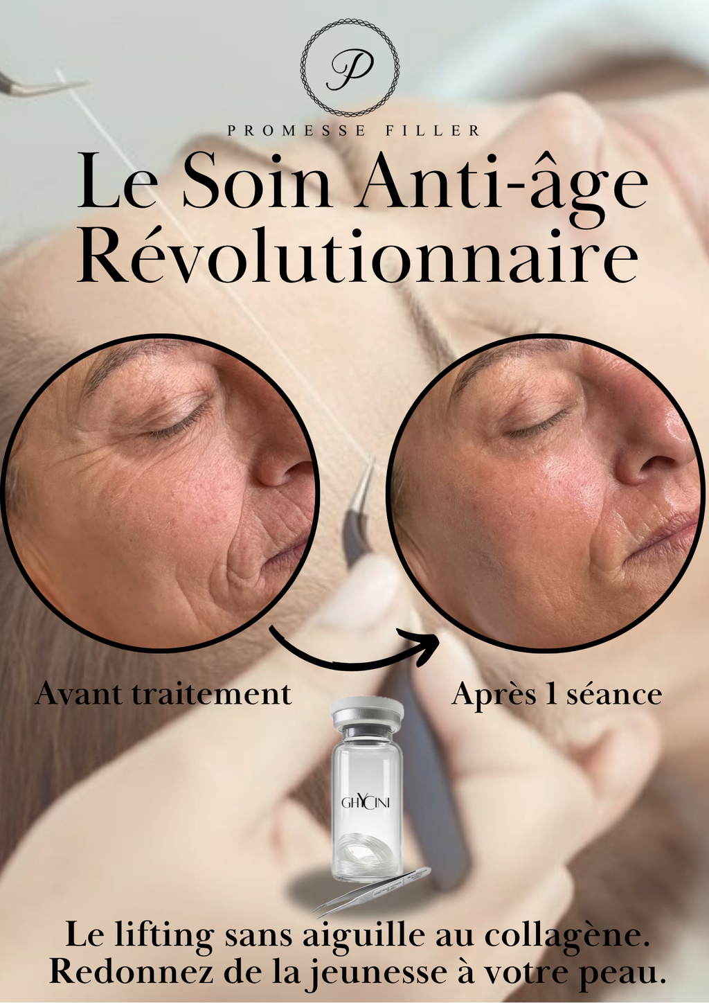 PLV - Fils de collagène - Promesse Filler