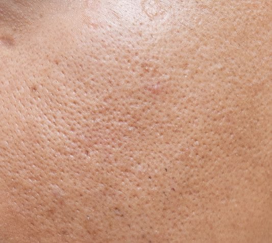peeling, anti points noirs, acné, soin médico esthétique, pore dilatés, excès de sébum 