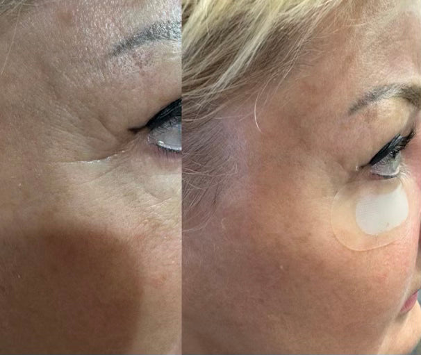 PATCH MICRONEEDLING POUR RIDULES