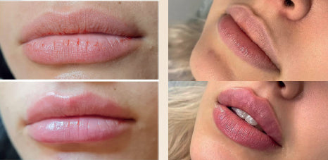 WEICHE LIPPEN + LIDOCAINE INFINITE FILLER PREMIUM